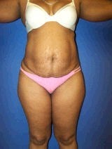 Tummy Tuck (Abdominoplasty) before 428737