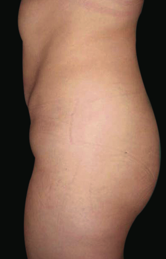 Tummy Liposuction after 229684