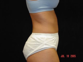 Liposuction of Abdomen, Waist, Flanks, Outer Thighs with 6 Pack Abdominal Etching before 203552