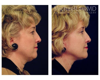 Facial Rejuvenation - Neck Lift 395191
