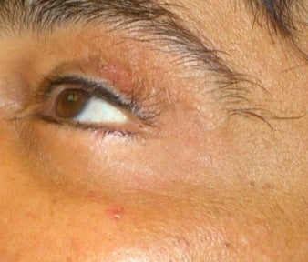 Laser Vein Treatment after 374366