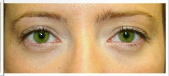 Lower Eyelid Surgery after 526491