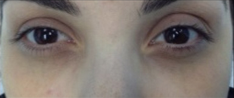 PRP (platelet rich plasma) after 570929