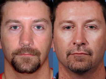Revision rhinoplasty before 355697