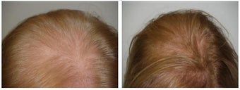 Low Lever Laser Light Therapy before 358811