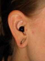 Earlobe Repair before 157517