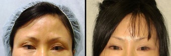Endoscopic Brow Lift before 649406