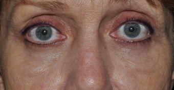 Bilateral upper and lower blepharoplasty, and 4 lid permanent eyeliner after 277496
