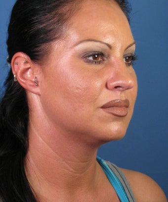Liposuction before 446439