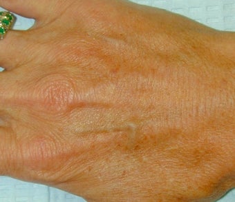 Sclerotherapy treatment for hand after 371748