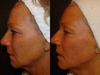 Ultherapy before 529424