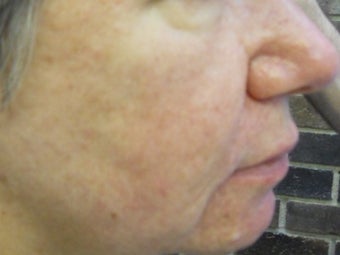 Severe Acne after 271995
