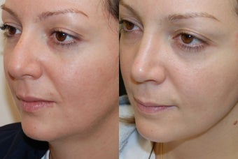 Rhinoplasty 7 months post-op. 3/4 view before 140301
