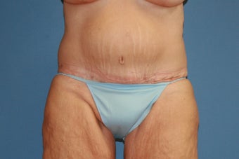 Abdominoplasty after massive weight loss after 91275
