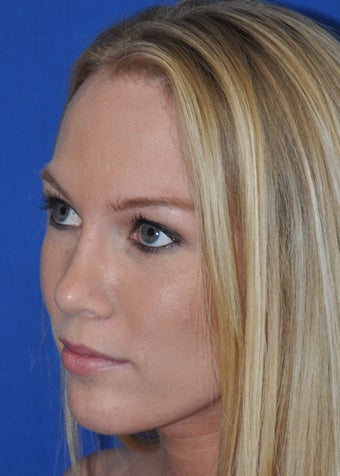 Rhinoplasty 373784