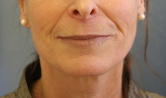 Juvederm injection before 343529