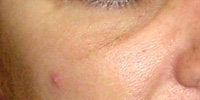 Sculptra after 272059