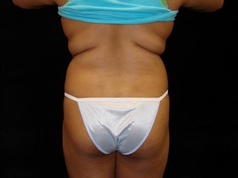 Brazilian Buttocks Lift before 246900