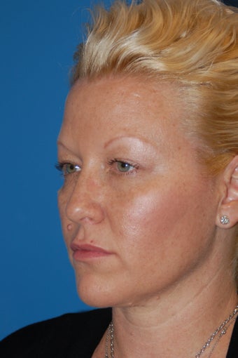 Blepharoplasty or "eyelid lift" before 502053