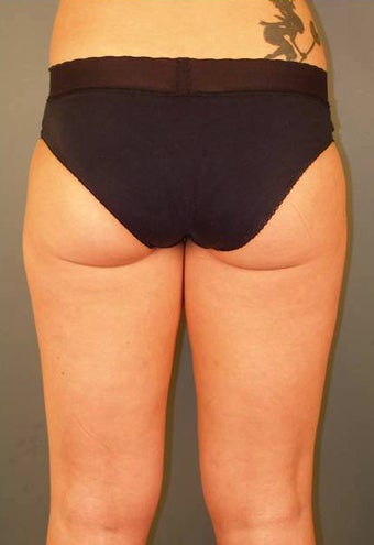 Tumescent Liposuction Under Local Anesthesia. after 331479