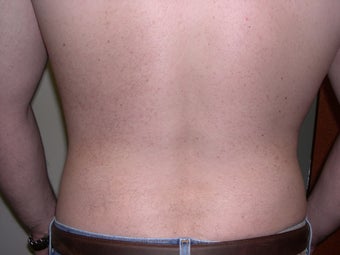 Liposuction 340028