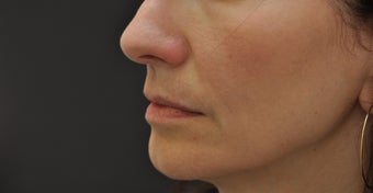 Juvederm Ultra after 194332