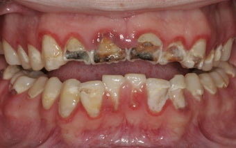 Full Mouth Reconstruction 382036