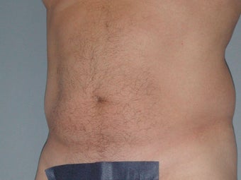 Liposuction 581438