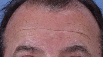Botox to forehead before 240866