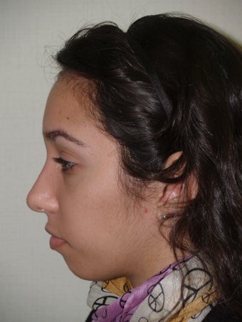 Rhinoplasty- external approach after 174850