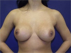 Breast augmentation before 592886