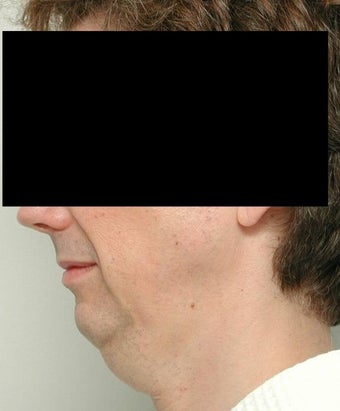 Neck Lift and Chin Implant before 106455