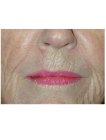 Lip skin cancer reconstruction after 84503