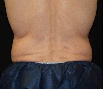 CoolSculpting on love handle and flank areas before 482900