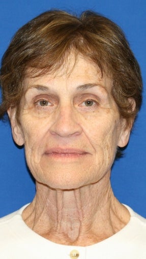 Facelift, Browlift, & Skin Pinch before 540327