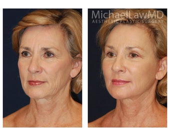 Facial Rejuvenation before 395153