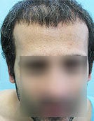 FUE – BHT by SFET Using Nape, Beard and Chest Hair Only before 196037