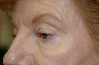Cheek augmentation with cheek lift, ptosis repair, and elimination of festoons 341472