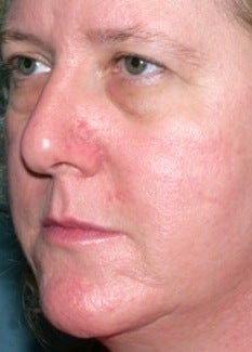 PDL for rosacea after 374579