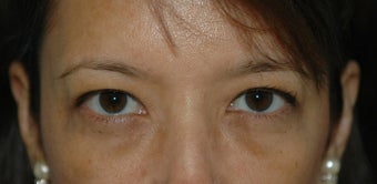 Upper Blepharoplasty before 125923