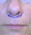 Face and Brow Lift and Eyelid Surgery 149153