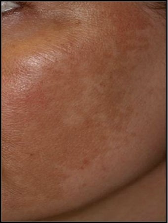 Fraxel - Melasma before 652321
