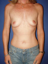 Breast Augmentation with Silicone Gel Implants before 122671