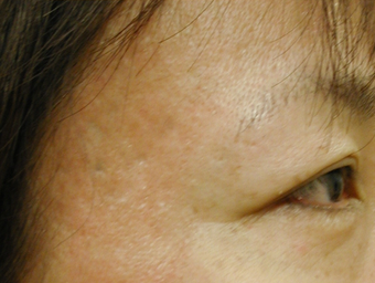Acne Scars after 200602