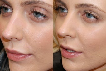 Non-Surgical Rhinoplasty before 161994