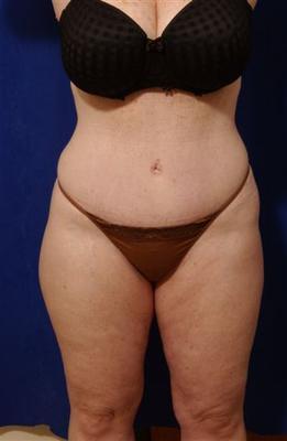 Abdominoplasty with liposculpture after 59762