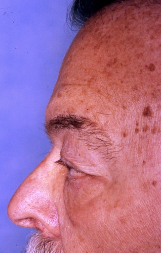 Blepharoplasty 322229