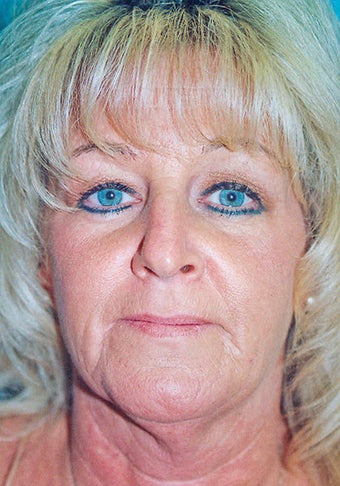 Lower Facelift & Neck Lift (w/ Liposuction) + Blepharoplasty before 280774