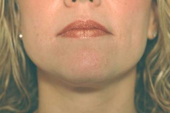 Laser Acne Treatment after 82958