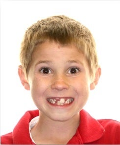 Early Orthodontic Treatment before 344757